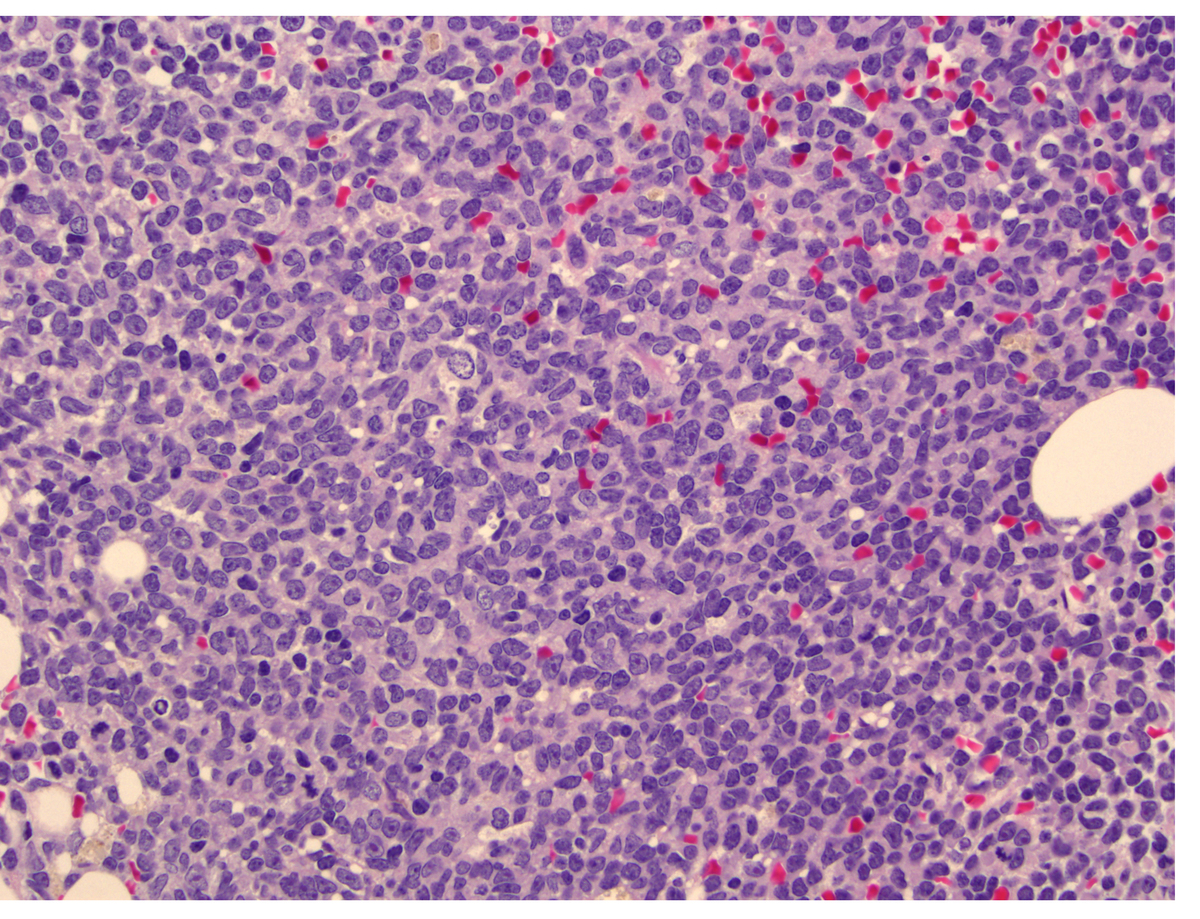 Bone marrow biopsy, H&E.